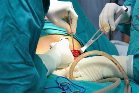 Caesarean section - planned operation or emergency procedure ...