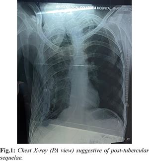 Anaesthetic Challenges in Emergency Laparotomy for a Patient with a ...