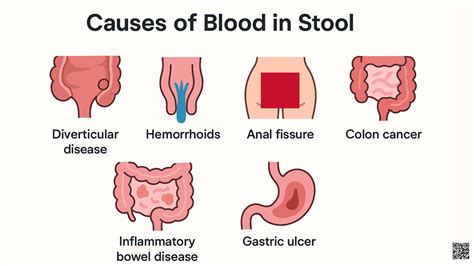 What Blood in Stool Looks Like: Understanding Stool Colors, Types, and Health Warnings