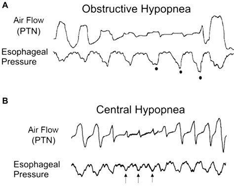 Sleep Studies Interpretation and Application - Otolaryngologic Clinics of North America