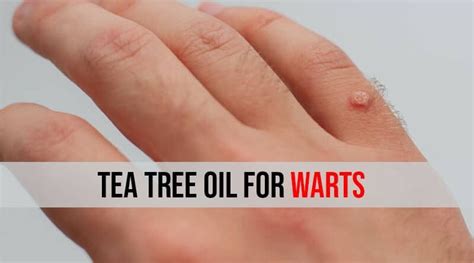 Image result for tea tree oil warts