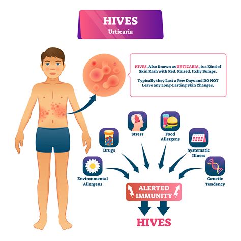 What is Urticaria or Hives? Learn the Causes & how to treat it.