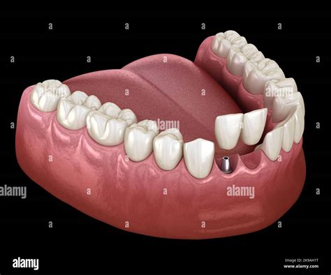 Cantilever bridge implant based, frontal tooth recovery. Medically ...