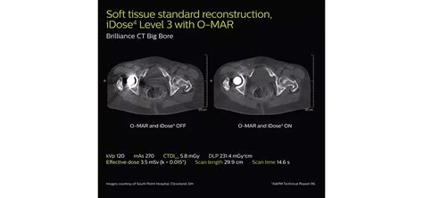 Philips – Brilliance Big Bore – Circular Edition refurbished CT scanner ...