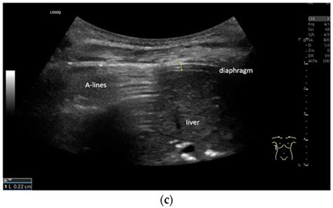The Perception of the Diaphragm with Ultrasound: Always There Yet ...