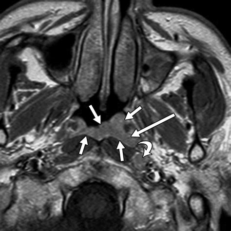 MRI and CT of Nasopharyngeal Carcinoma | AJR