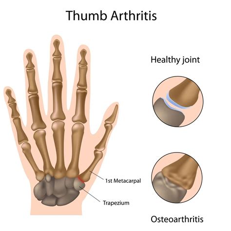Thumb Arthritis Surgery / Basal Joint Surgery | Andrew J. Leo, MD Andrew J. Leo, M.D.