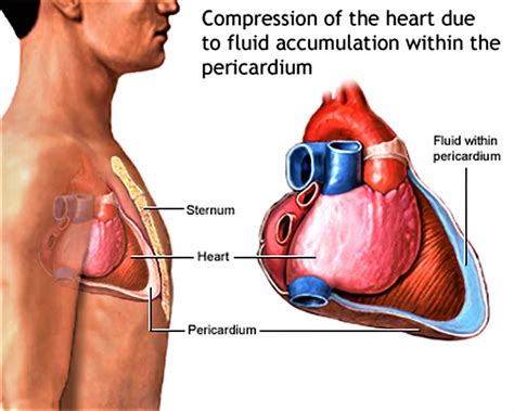 Cardiac tamponade causes, signs, symptoms, diagnosis and treatment