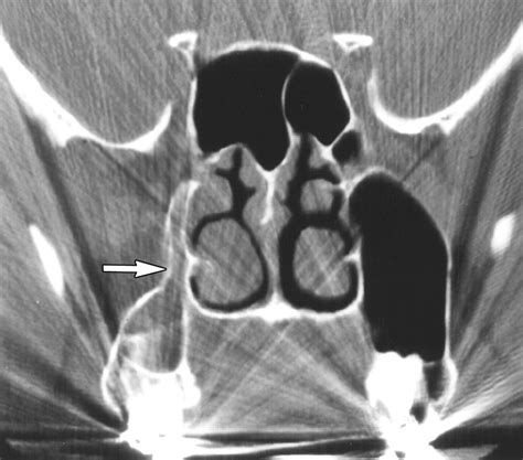 The Silent Sinus Syndrome Clinical and Radiographic Findings | AJR