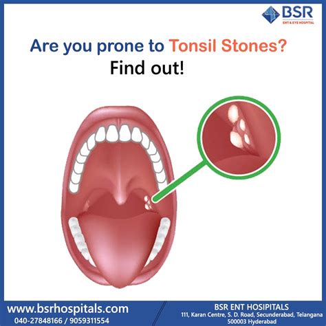 Tonsil Stones Specialists at Kevin Christensen blog