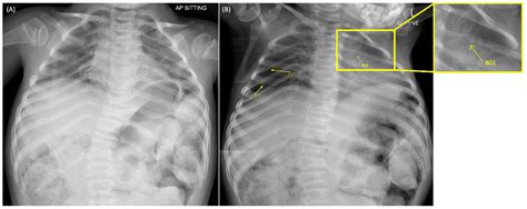 Point of Care Ultrasound Identification of Multiple Rib Fractures in a Pediatric Patient with ...