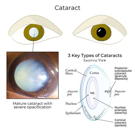 Cataracts Types