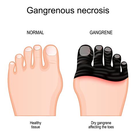 Exploring Gangrene: A Comprehensive Guide to Its Types, Risk Factors ...