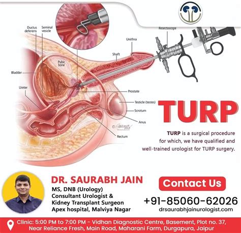 Understanding Transurethral Resection of the Prostate (TURP)