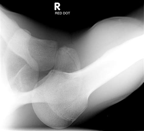 Posterior Shoulder Instability & Dislocation - Shoulder & Elbow ...