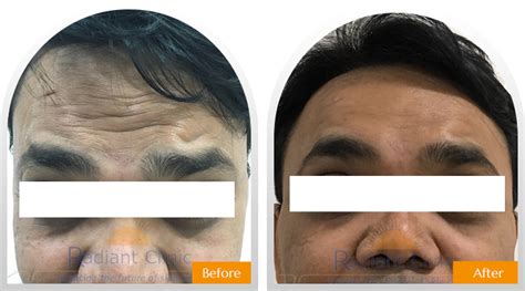 Before-After | Skin and Hair Treatment Results - Radiant Clinic