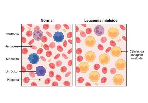 Quais são os tipos de leucemia? - Cursau Educação - Blog