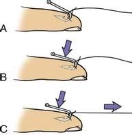Image result for String Yank Method