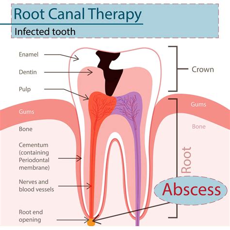Root Canal Treatment — Klein Family Dental