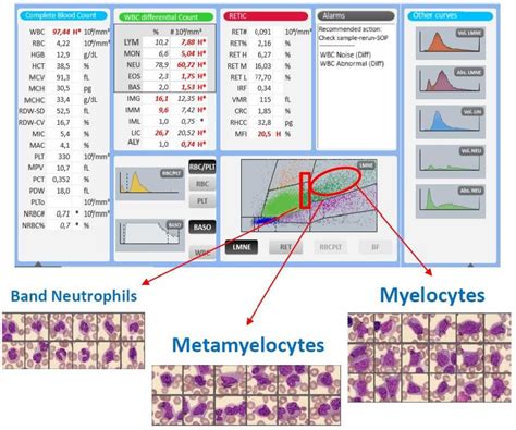 Acute Myeloid Leukemia (Clinial Case)