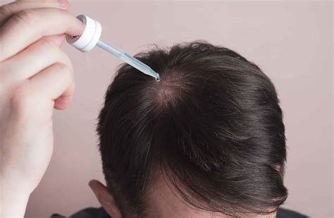 5 Doctor-approved Treatments and Medications for Hair Loss