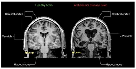 Does Alzheimer's Show Up On An Mri | Detroit Chinatown