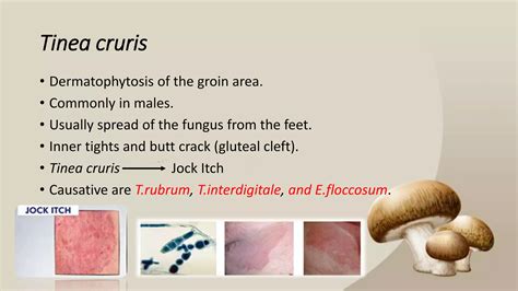 Tinea cruris(Jock itch) | PPSX