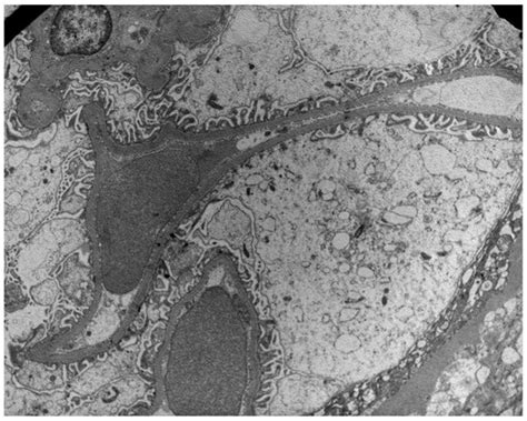 Urine Nephrin and Podocalyxin Reflecting Podocyte Damage and Severity ...
