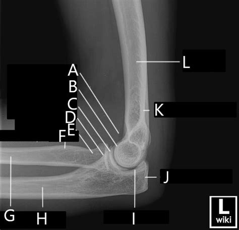 Image result for Elbow Contralateral