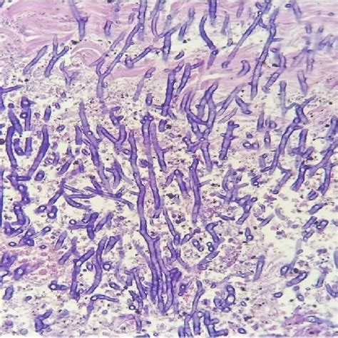 Image result for Devitalized Tissue Example
