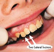 incisors 的图像结果