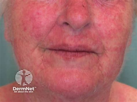 https://dermnetnz.org/assets/Uploads/dermatitis/acd-face/2435.jpg