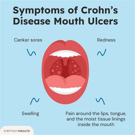 Canker Sore On Throat Symptoms