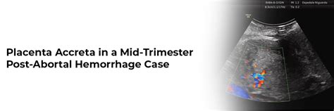 Placenta accreta in a mid-trimester post-abortal hemorrhage case