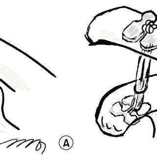 Image result for Transnasal Loop Fixation