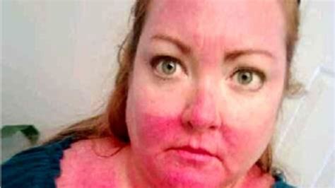 TMZ's Summer Sunburn Snapshots Contest
