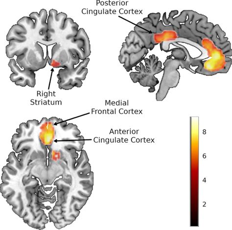 Cingulate cortex Disorders 的图像结果