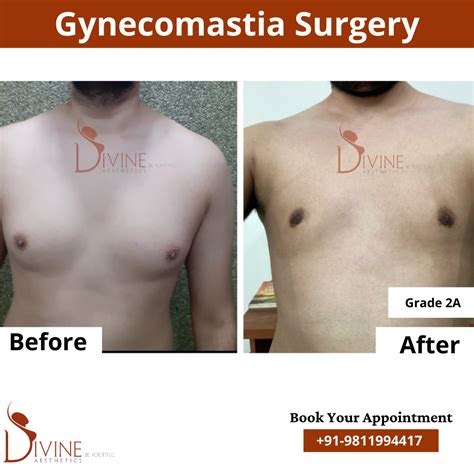 Gynecomastia Before After Photos - Before After Surgery Photos