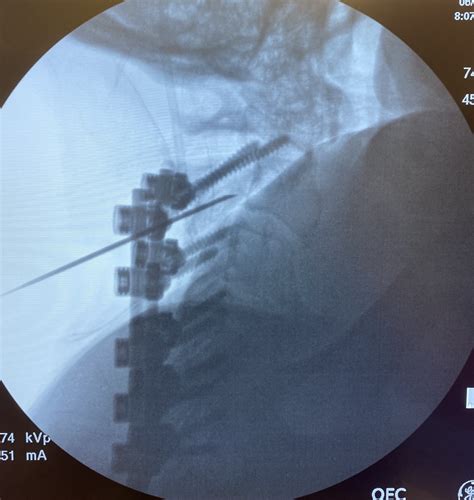 Case Report: Percutaneous Peripheral Nerve Stimulation for the Treatment of Occipital Neuralgia ...