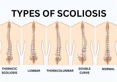 Types Of Scoliosis
