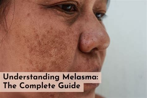 Melasma specialist in Delhi, Melasma Removal in Delhi, saket | SkinQure