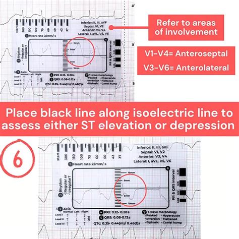 ZTGD ECG 7 Step Ruler, ECG 7 Step Ruler for ECG/EKG India | Ubuy