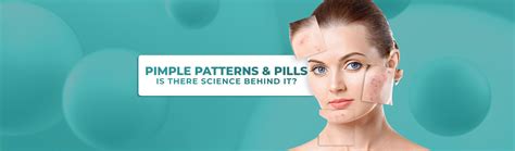 Pimple Patterns & Face Mapping: What Science Really Says