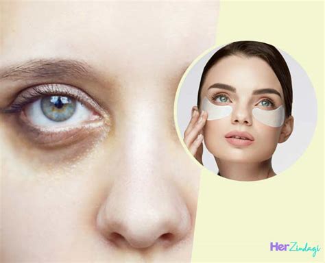 डार्क सर्कल्‍स से परेशान महिलाएं ये 5 घरेलू नुस्‍खे आजमाएं, दिखता है ...