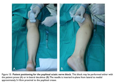 Sciatic Nerve Block