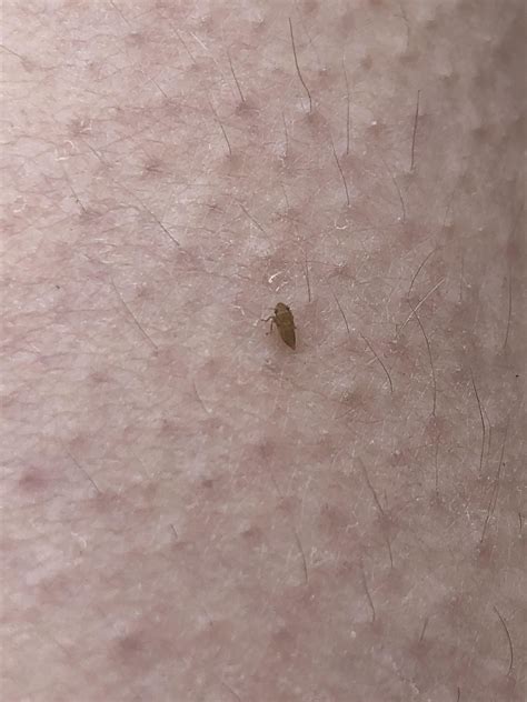 Simple and effective home remedies for treatment of seed ticks – Artofit