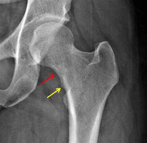 X-Ray Of Femoral Neck Fracture at Ester Gordan blog