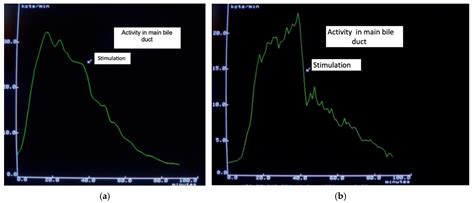 Personalized Treatments for Functional Disorders of the Sphincter of Oddi: A Short Muscle with a ...