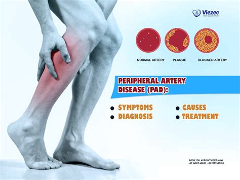Reverse Peripheral Artery Disease Symptoms – WYCK