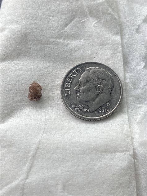 3mm out. 11mm to go. : r/KidneyStones